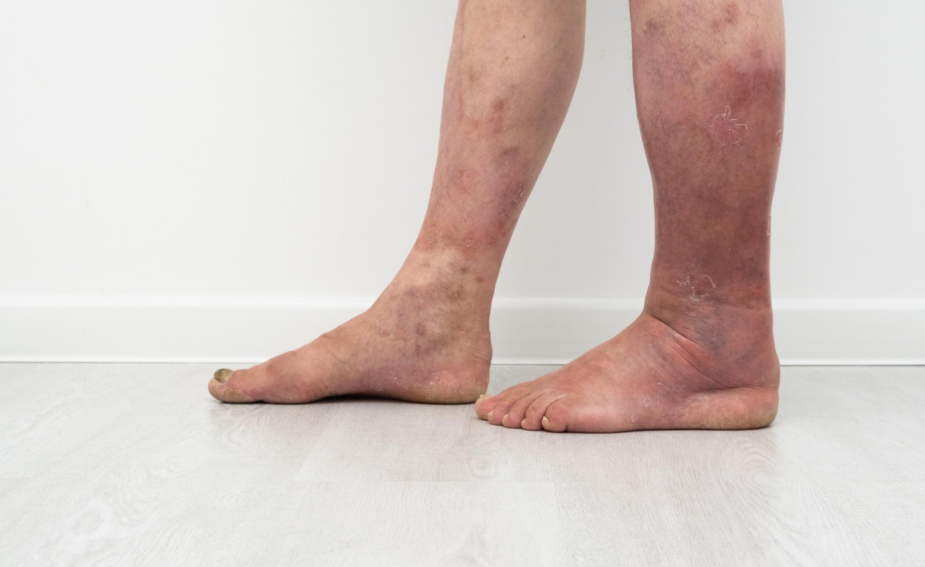 Varicose eczema